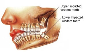 wisdom teeth evolution